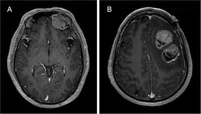 Intracranial dissemination in a primary small cell carcinoma of the brain: a case report and literature review